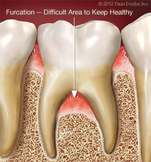 Furcation - Difficult Area to Keep Healthy.