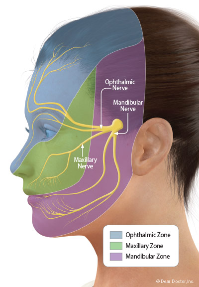 Trigeminal Neuralgia Nerves and Zones.