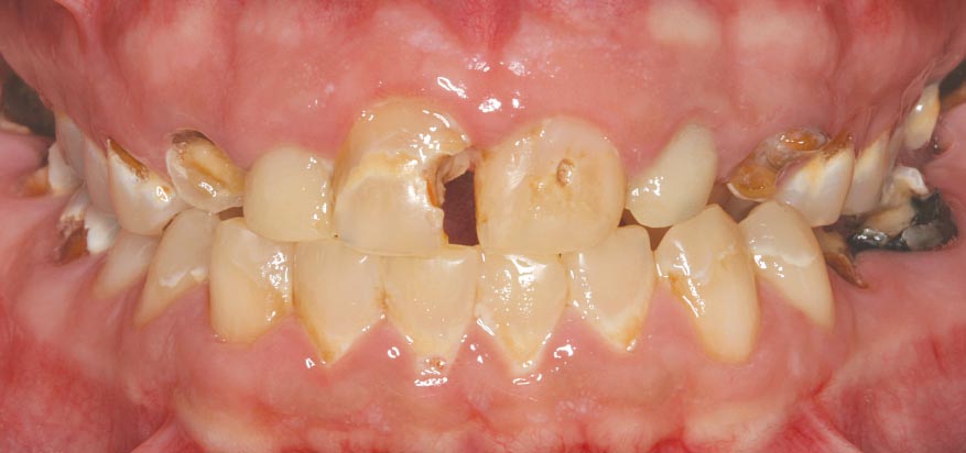 Vaping damage to teeth.