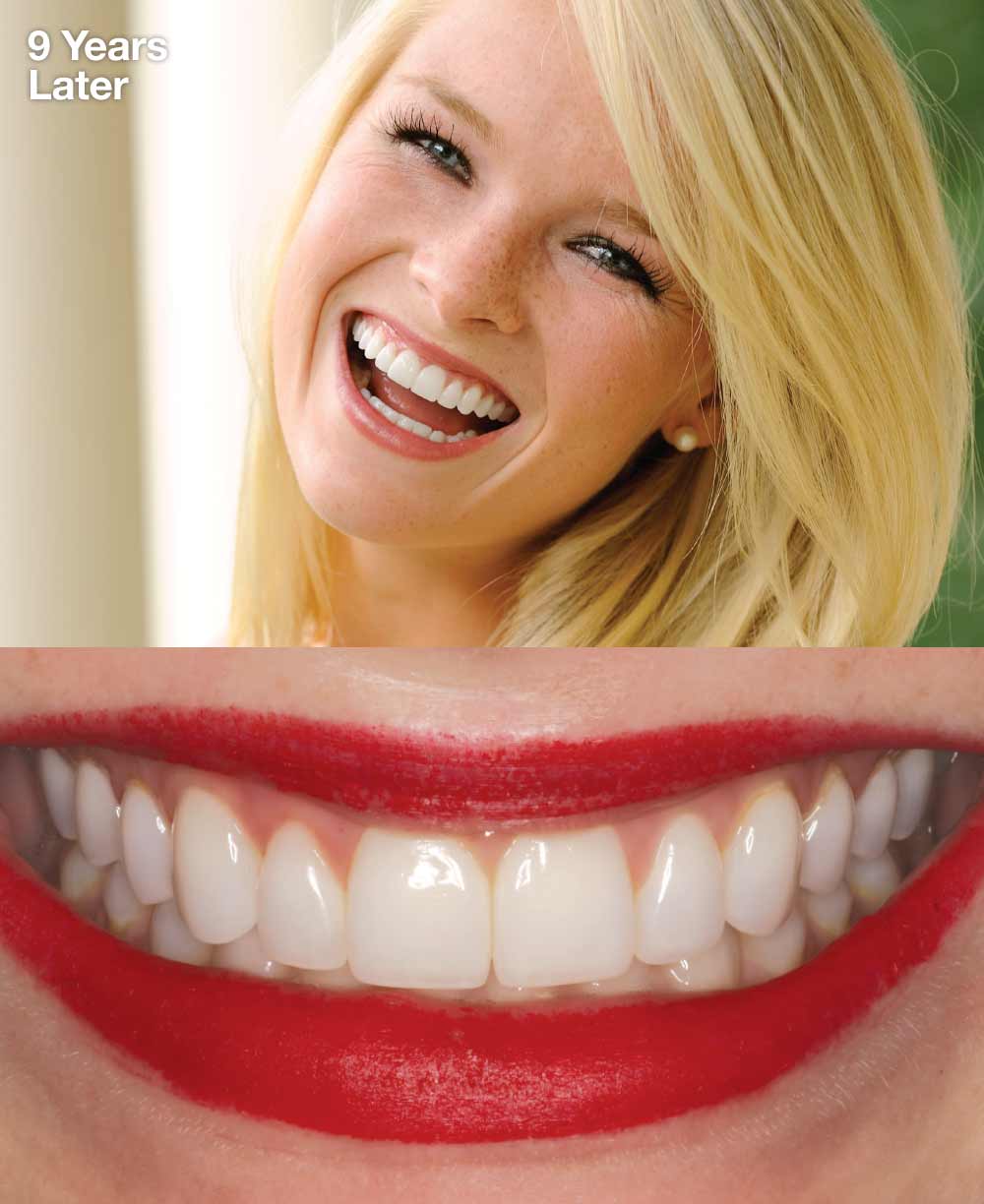 Teenager after porcelain veneers - 9 years later.