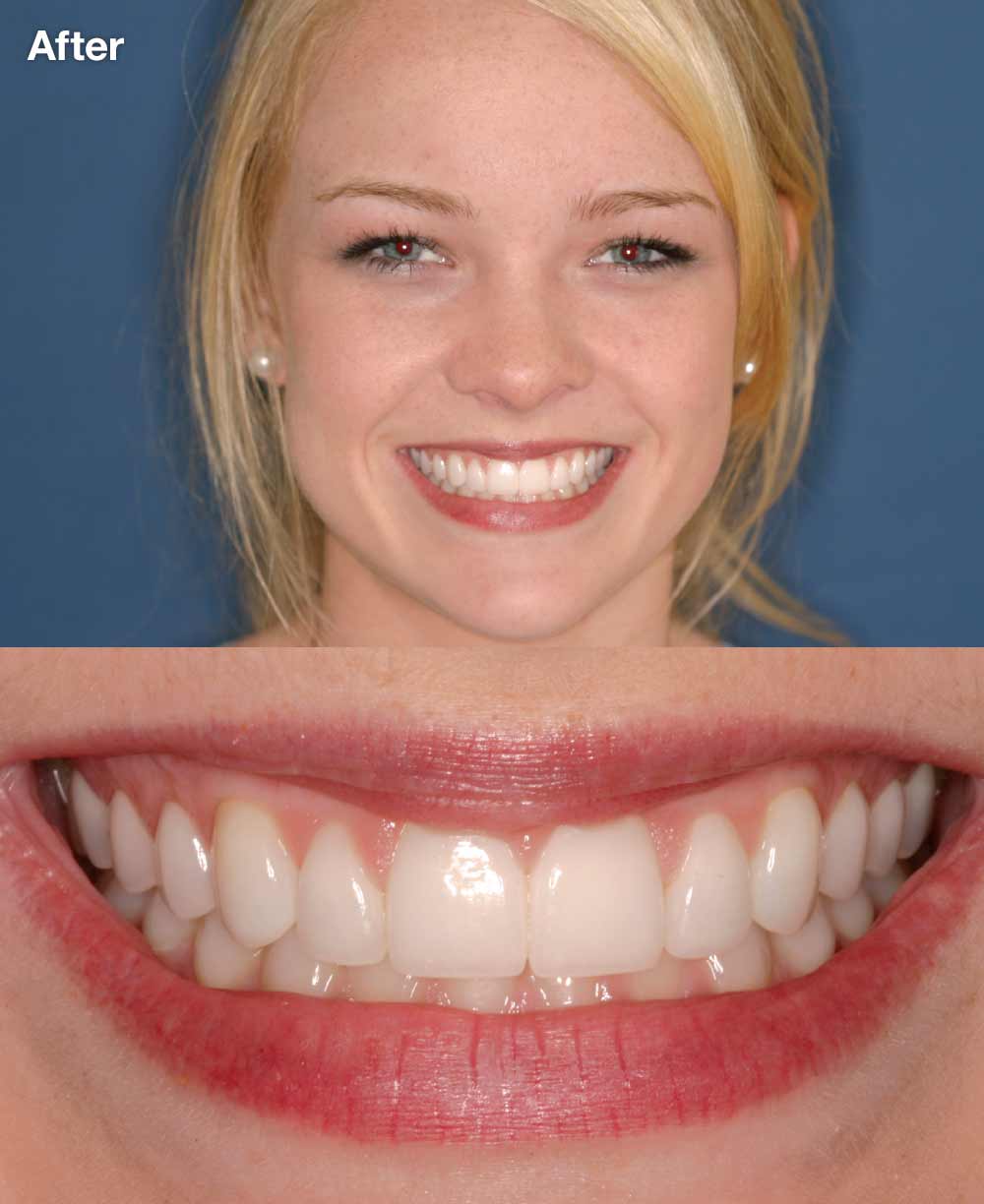 Teenager after porcelain veneers.