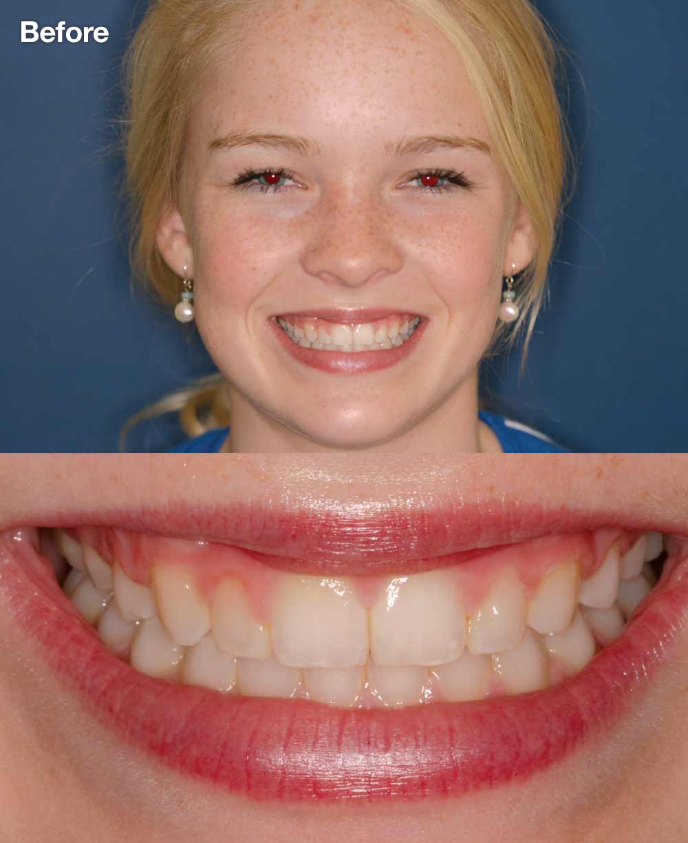 Teenager before porcelain veneers.