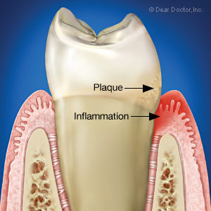 Warning signs of gum disease