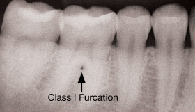 Class 1 furcation.