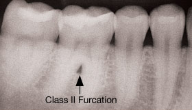 Class 2 furcation.