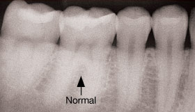 Normal furcation.