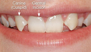 Missing lateral incisors.