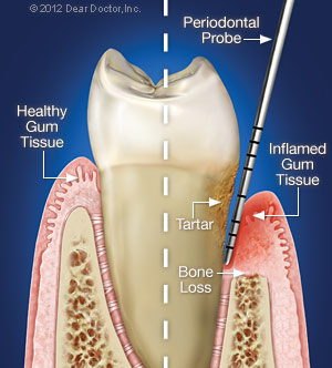 Periodontal Gum Disease.