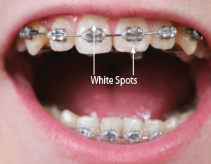 White spots on teeth during orthodontic treatment.