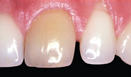 Before whitening