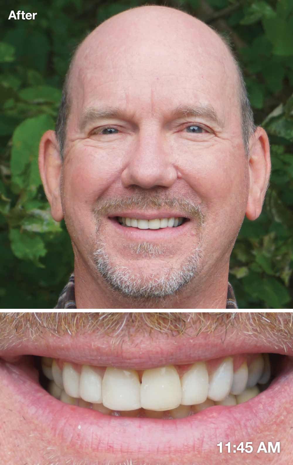 After direct veneers.