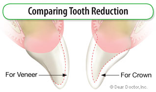 Comparing tooth reduction.