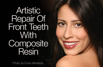 Repair of front teeth with composite resin.