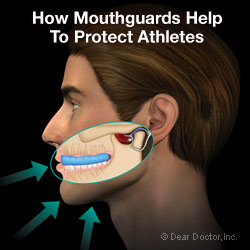 How mouthguards help to protect athletes