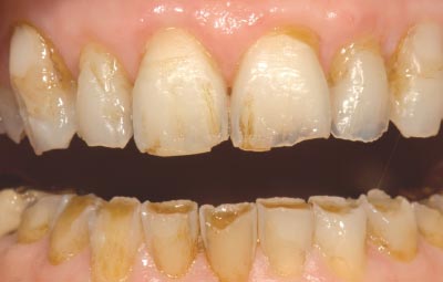 Front teeth before treatment.