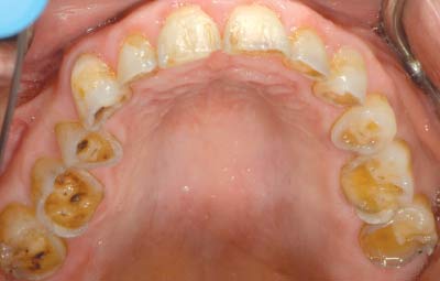 Tooth wear and erosion.