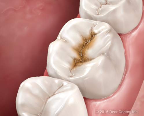 Cavities tooth decay.