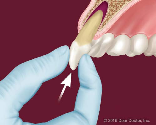 Knocked-Out Permanent Tooth.