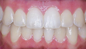 After Invisalign clear aligners.