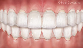 Invisalign clear orthodontic aligner.