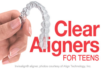 Invisalign clear orthodontic aligners for teenagers.