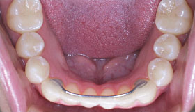 Wire bonded to teeth after orthodontics.