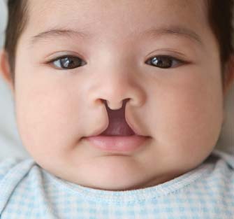 Complete bilateral cleft lip.