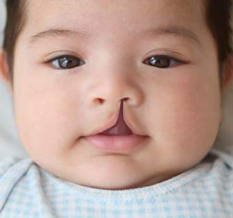 Complete unilateral cleft lip.