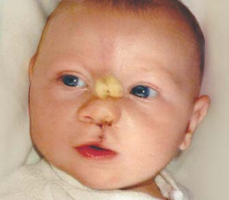 Cleft lip repair surgery.