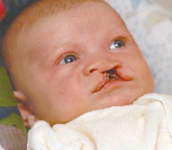 Harry with bilateral cleft lip.