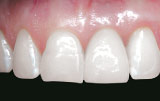 Dental implants after.