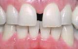 Orthodontics before.