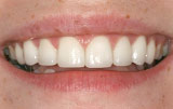 Porcelain veneers after.