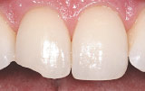 Teeth bonding before.