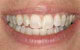 Teeth whitening after.