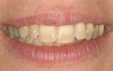 Teeth whitening before.