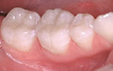 Tooth colored restorations after.