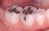 Tooth colored restorations before.