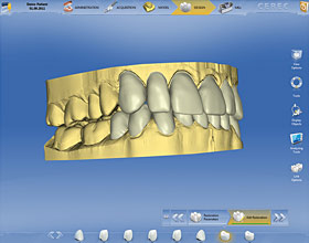 Cerec CAD/CAM 3d model on computer screen.