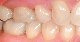 After CAD/CAM Cerec.