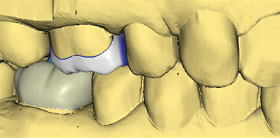 Computer model using CAD/CAM Cerec.