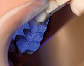 Cerec CAD/CAM scanning wand blue light.