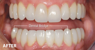 After Dental Bridge.