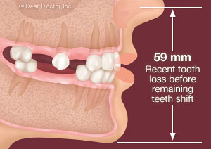 Loss of back teeth causes a slight loss of facial height.