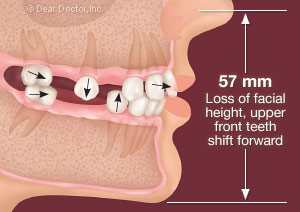 Without replacement of back teeth the teeth begin to shift.