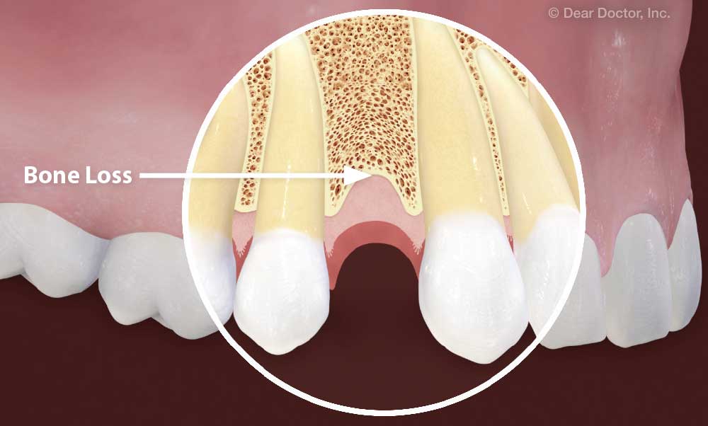 Bone loss.