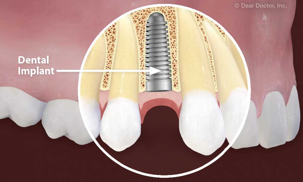 Dental implant placement.