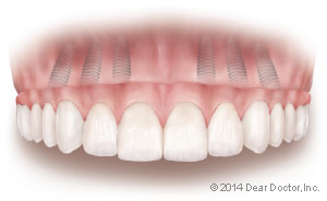 Single dental implant with temporary crown.