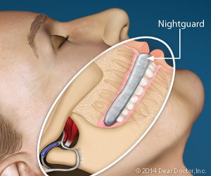 Nightguard for dental implants.