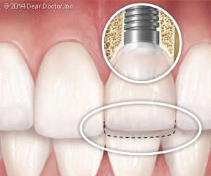 Single dental implant with temporary crown.